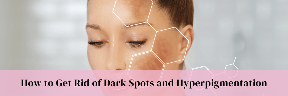How to Get Rid of Dark Spots and Hyperpigmentation